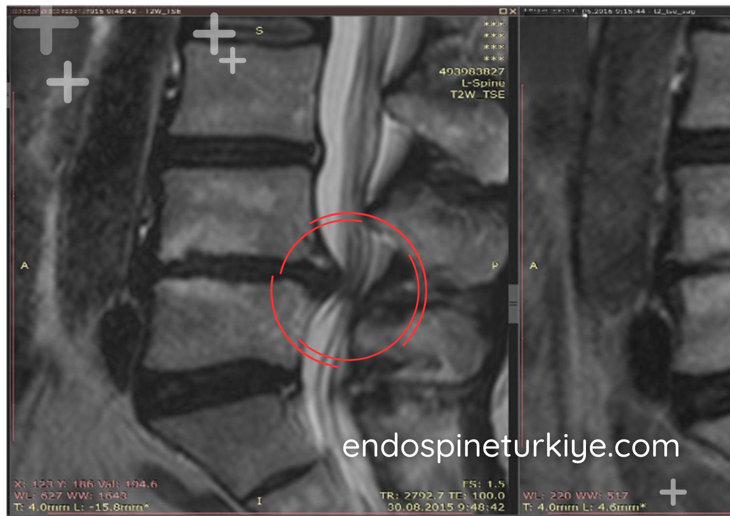 Bel fıtığı belirtileri - bel ve bacak ağrısı şeması