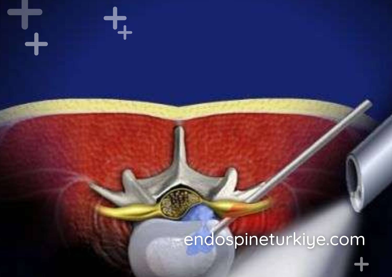 Tam kapalı belde dar kanal ameliyatı - lomber kanal darlığı tedavisi