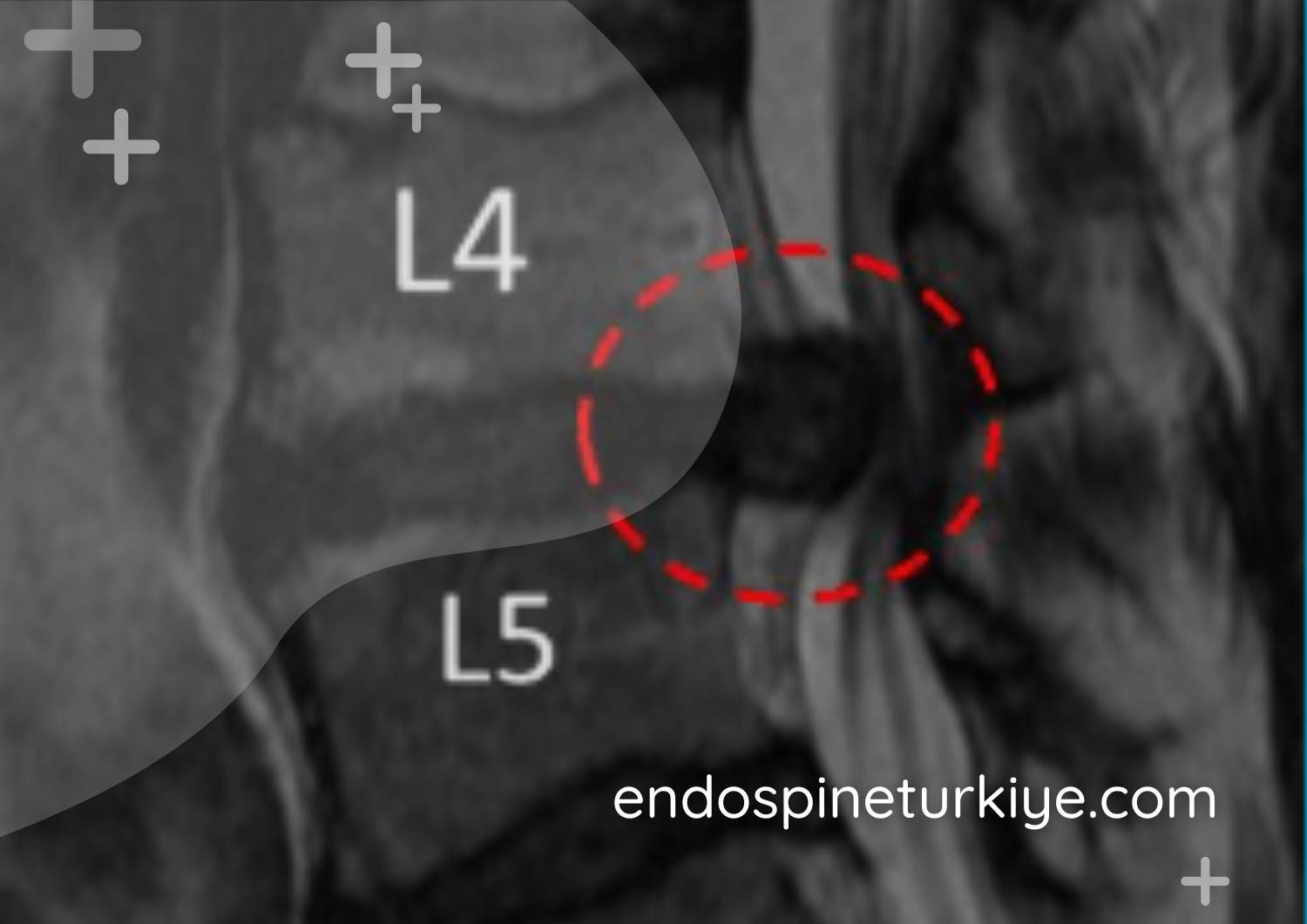 Tam kapalı dar kanal ameliyatı öncesi MR - kanal darlığı görüntüsü