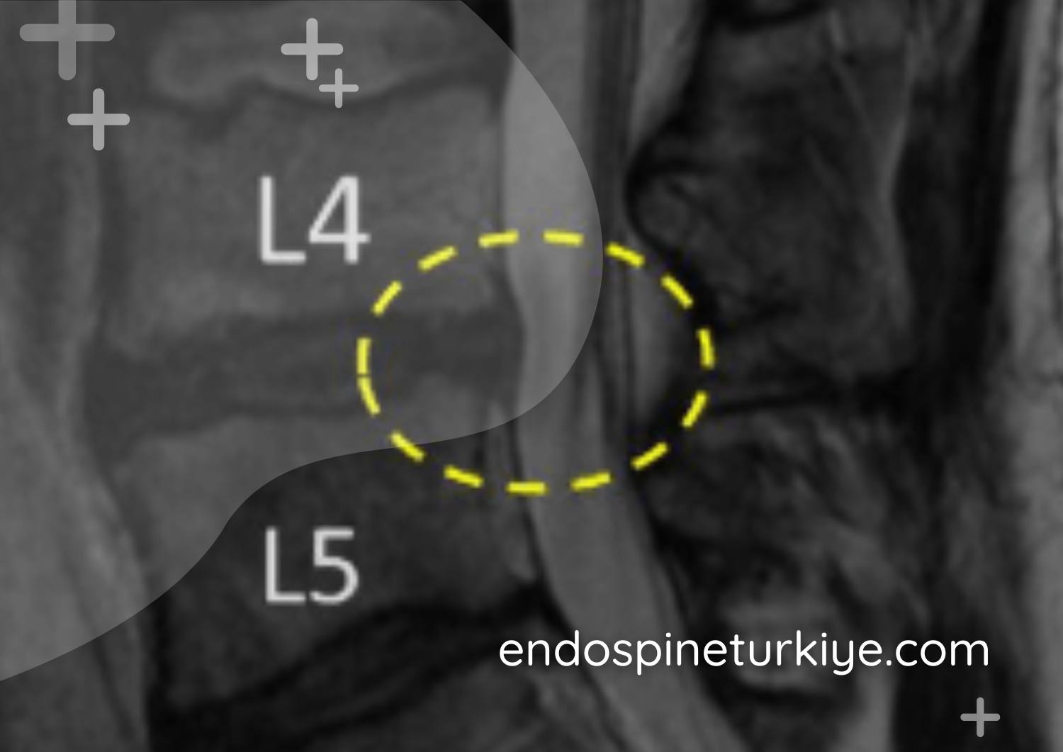 Tam kapalı endoskopik dar kanal ameliyatı sonrası MR - dekompresyon sonucu