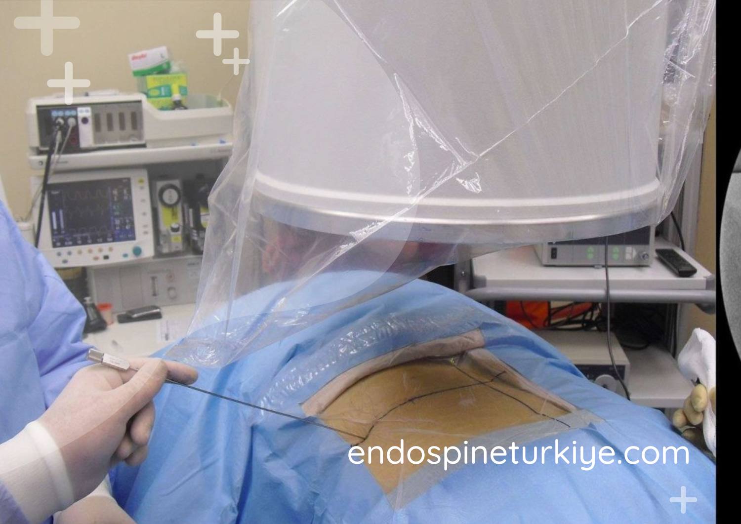 Endoskopik görüntüleme sistemi - tam kapalı ameliyatta kullanılan HD endoskop teknolojisi