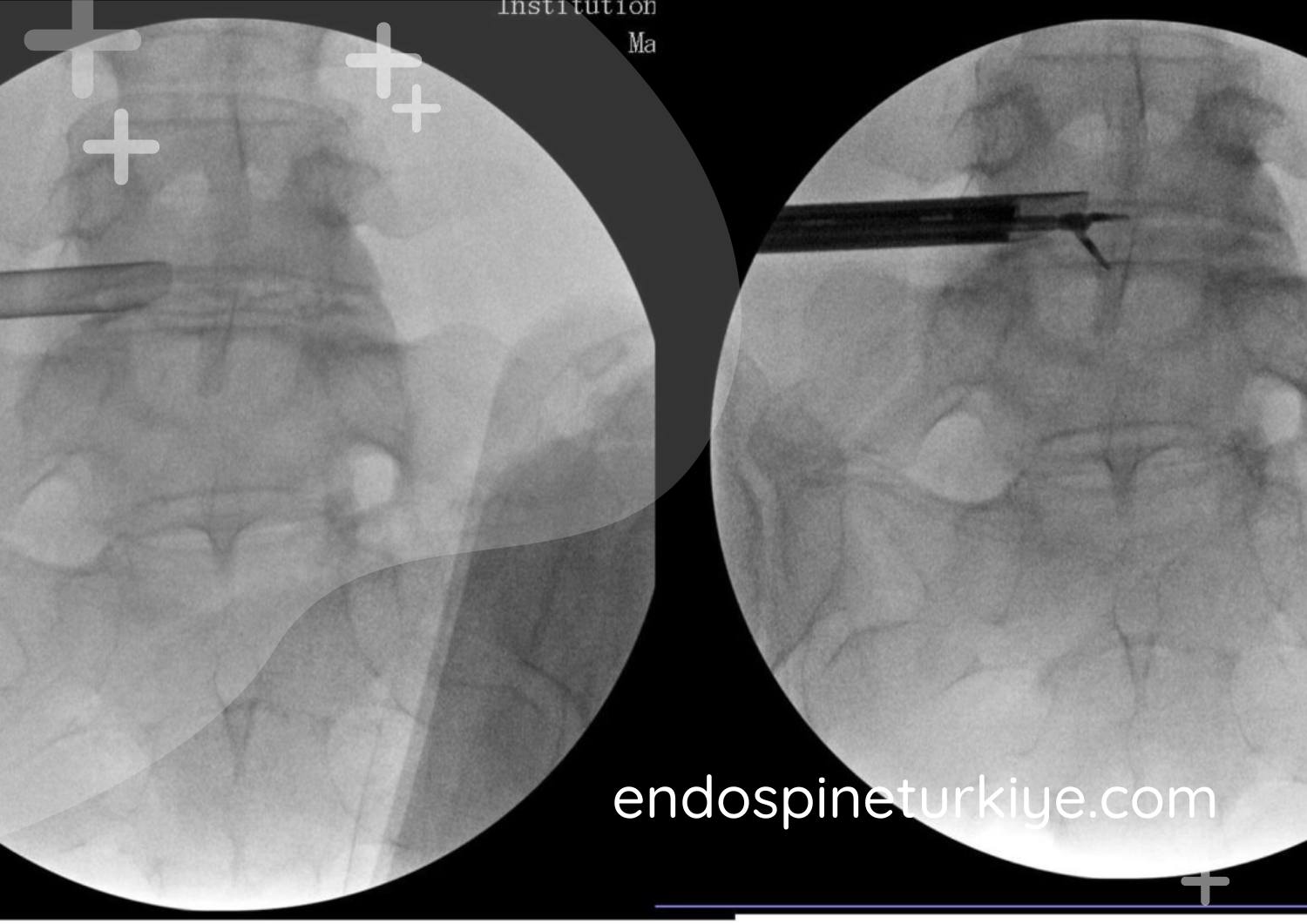 Endoskopik bel fıtığı ameliyatında 6mm minimal kesi - dikiş gerektirmez