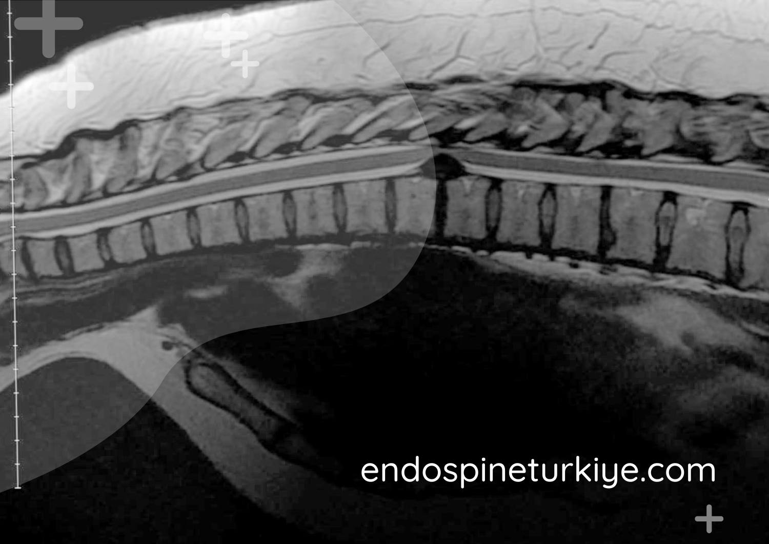 Torakal MR görüntüsü - sırt fıtığı teşhisi